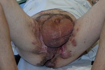 Name:  Hidradenitis-scrotum.jpg
Views: 1799
Size:  26.9 KB