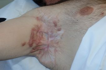 Name:  Hidradenitis-underarms.jpg
Views: 1243
Size:  22.4 KB
