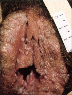 genital-warts-female.jpg