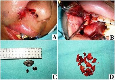 grenade_wound_in_the_right_nasogenian_region.jpg