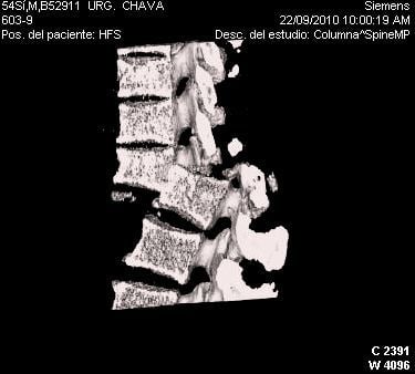 dislocated spine.jpg