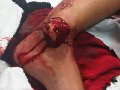 shauns-fractured-fibula-compound-ankle-dislocation-playing-baseball-warning-graphic-fracture-ima.jpg