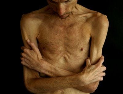 anorexia - Bryan Bixler #4.jpg
