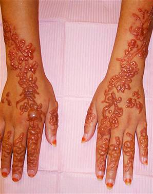 080807-henna-allergy-vmed-1p_widec.jpg