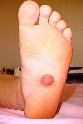 nipple-foot-MAIN_1346263a.jpg