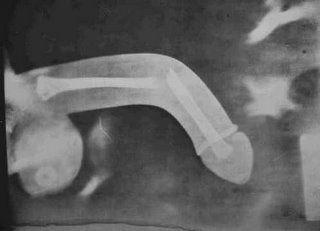 penis-fracture.jpg