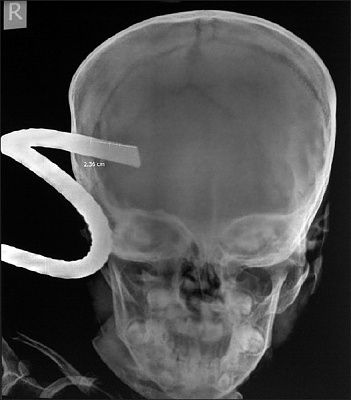 x-ray-skull-showing-iron-rod-penetrating-inside.jpg