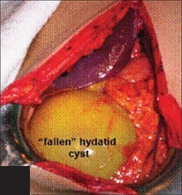 cyst.jpg