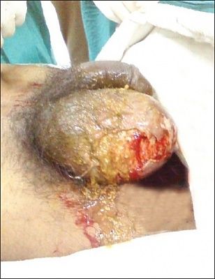 hernia-1-.jpg