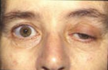 220px-Myasthenia.jpg