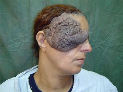 Plexiforgm-neurofibromatosis.jpeg
