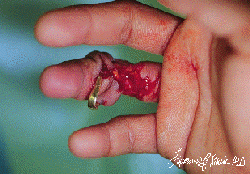 tnfinger.gif