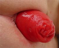 complete_prolapse.jpg