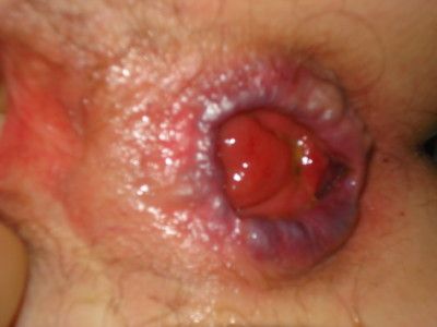 occult prolapse.JPG
