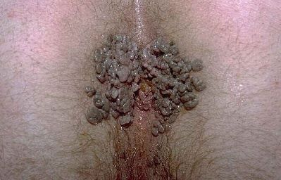 anal warts.jpg