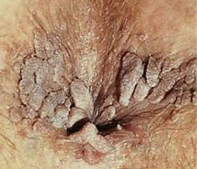 anal warts1.jpg
