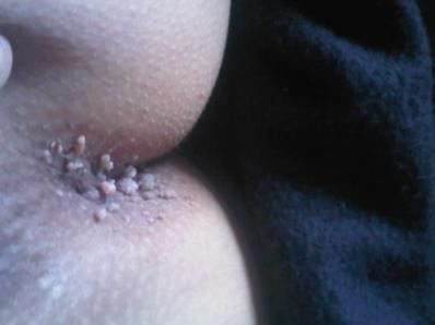 anal warts2.jpg