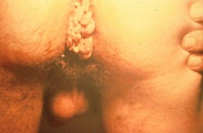 anal warts3 (1).jpg