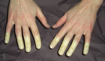 Raynauds-sized.jpg