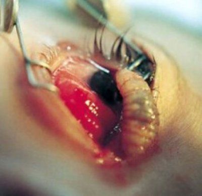 botfly-maggot-being-removed-human-eye..jpg