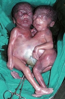 conjoined-babes.jpg