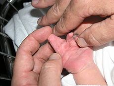230px-New_born_boy_showing_complete_complex_syndactyly_with_two_fingers_right_hand.JPG