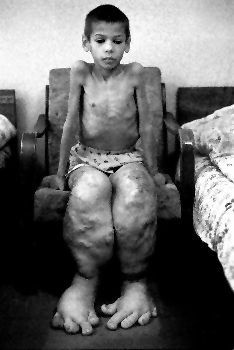 chernobyl-child-swollen-legs-feet1.jpg
