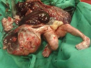 fetal-malformation-300x225.jpg