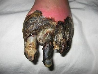 dry-gangrene.jpg