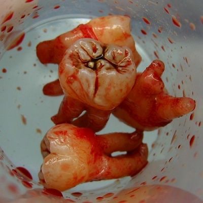 bloody-extracted-teeth.jpg