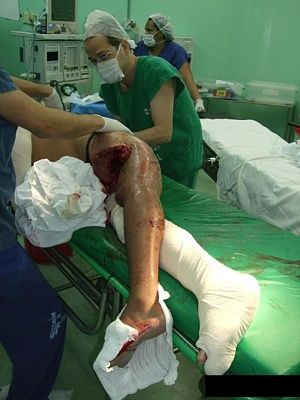 leg-wound.jpg