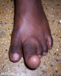 4815_diseases_macrodaclyly_l1.jpg