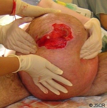 hernia.jpg