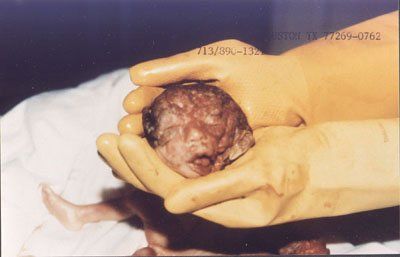 Name:  abortedbaby26.jpeg
Views: 1289
Size:  16.5 KB