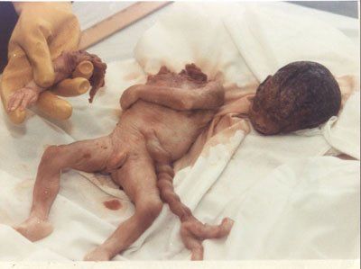 Name:  abortedbaby29.jpeg
Views: 786
Size:  19.6 KB