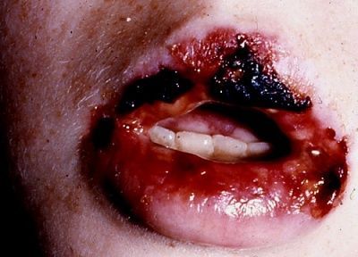 crusting-20of-20the-20lips-20caused-20by-20herpes-20simplex-20virus-20infection.jpg