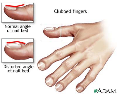 clubbed-fingers.jpg