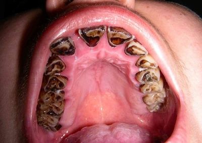 tobacco-stained-20teeth-2c-20of-20a-2027-20year-old-20who-20has-20been-20smoking-20since-20age-2.jpg