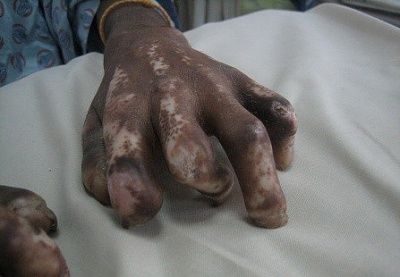 scleroderma-20with-20severe-20skin-20tightening-2c-20autoamputation-20of-20the-20distal-20digits.jpg