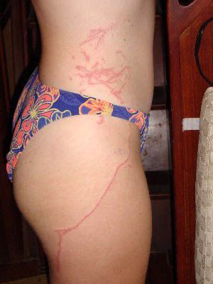 Suspected Chironex fleckeri Envenomation: Box Jellyfish Stings - Box%20Jellyfish2