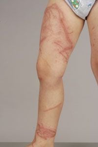 Suspected Chironex fleckeri Envenomation: Box Jellyfish Stings - jellyfish sting lewis is