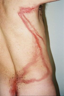 ligthening-20burn.jpg