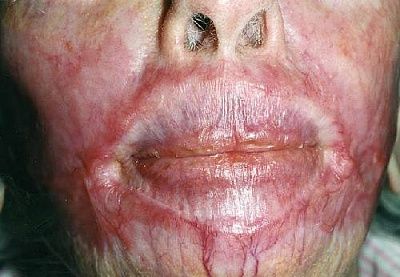 burn-20scars-20covering-20the-20lips.jpg
