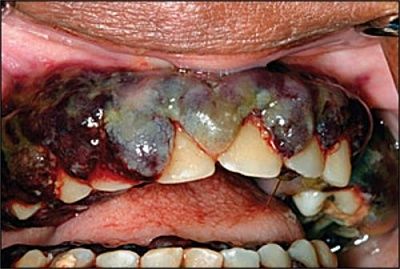 rotten-20mouth.jpg