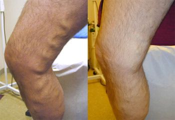 veins_leg11600.jpg