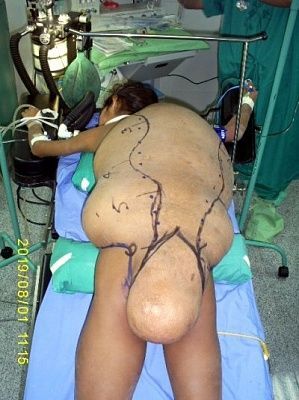 tumour.jpg