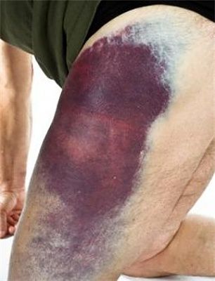 thigh-20bruise.jpg