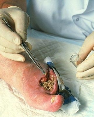 maggot-20therapy.jpg