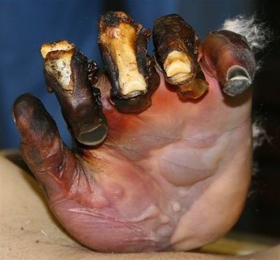 fourth-20degree-20burn-20with-20tissue-20charring-20and-20exposed-20bone.jpg