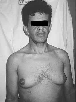 gynecoma.jpg